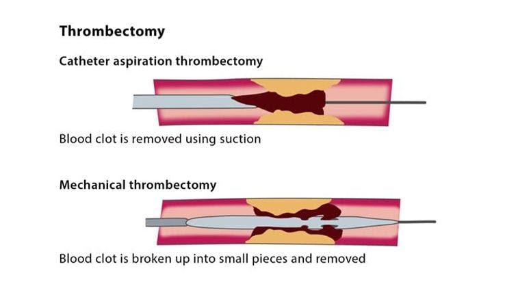 Case Study of Mechanical Thrombectomy
