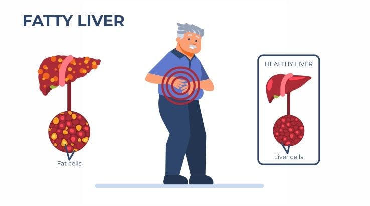 Fatty Liver Disease Symptoms,Causes and Treatments