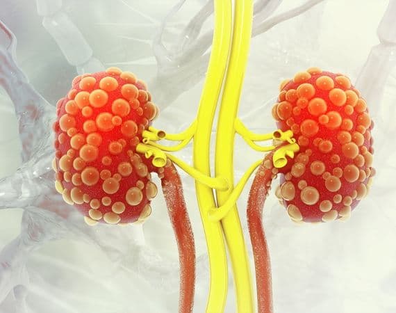 Poly-Cystic Kidney Disease (PKD)