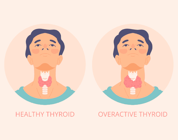 Thyroid diseases