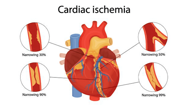 Ischemic Heart Disease