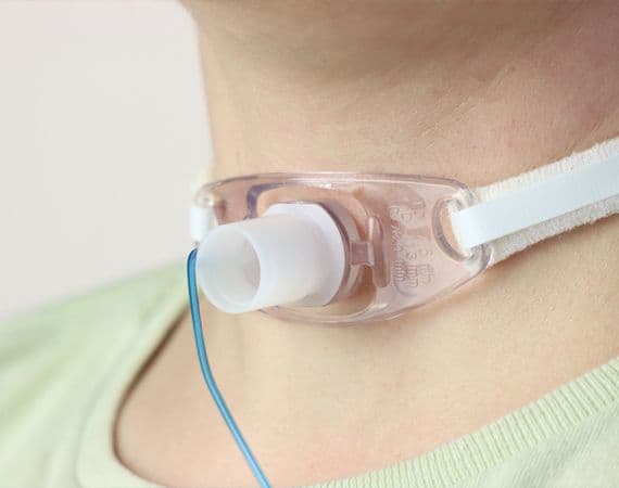 Tracheostomy