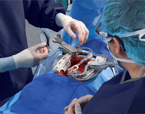 Coronary Artery Bypass Surgery