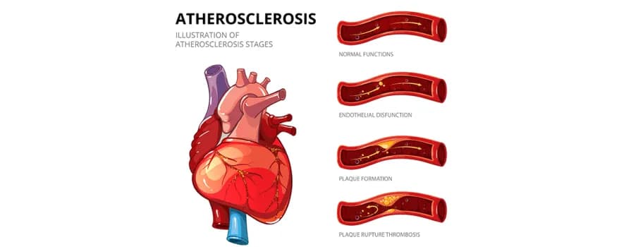 Atherosclerosis