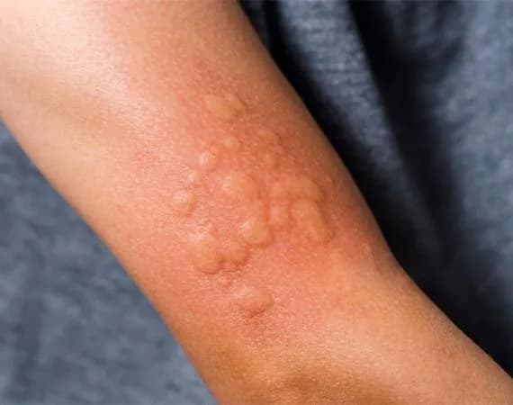 Urticaria