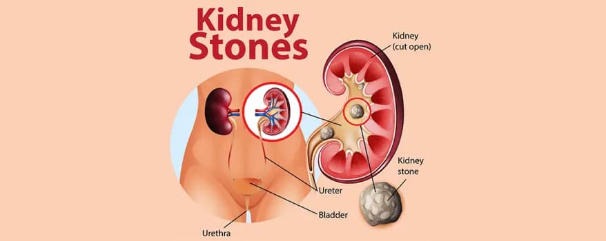 Kidney stones