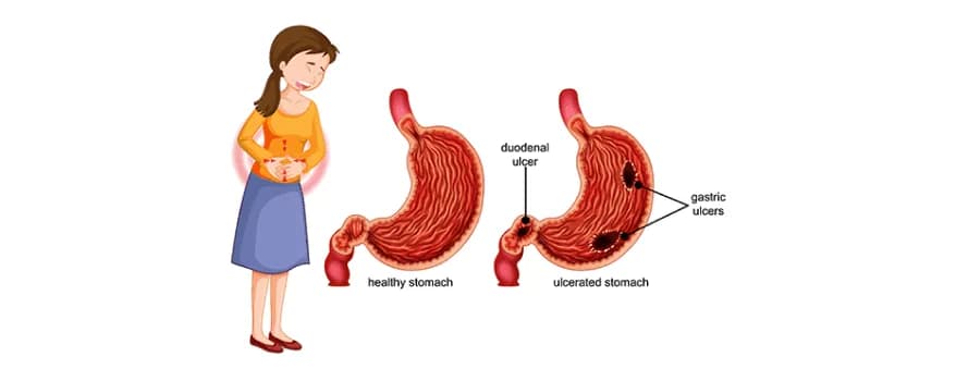 Peptic ulcer