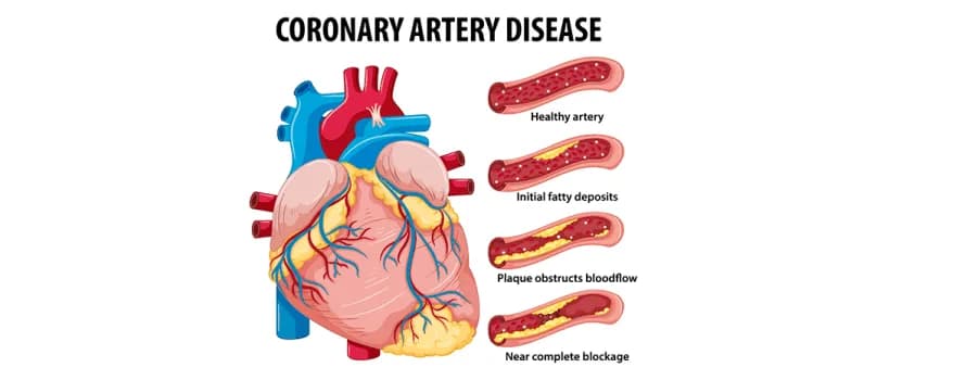 Coronary Artery Disease