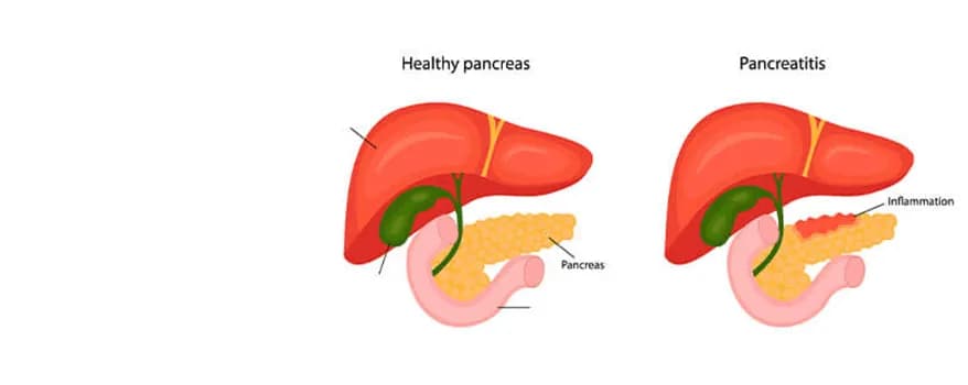 Pancreatitis