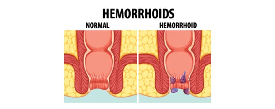 Haemorrhoids