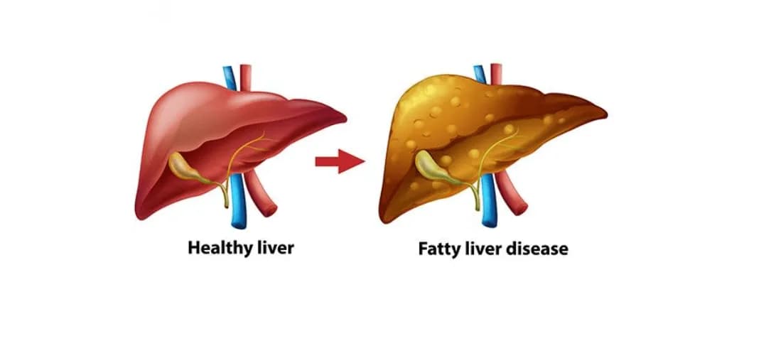 Non Alcoholic fatty liver disease