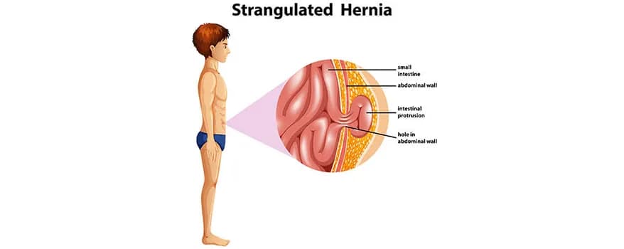 Hernia