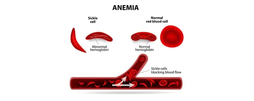 Sickle cell anemia