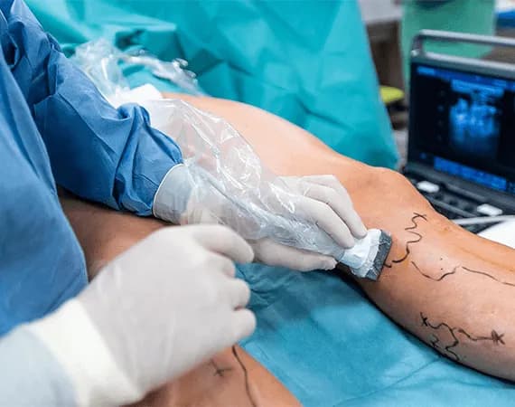 Varicose Veins Surgery