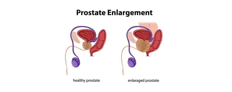 Prostate enlargement