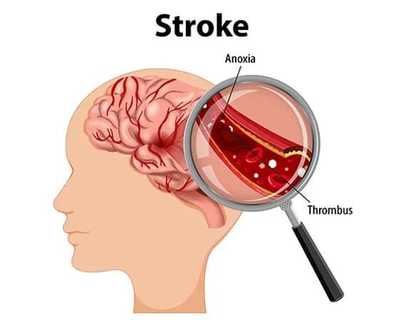 Stroke