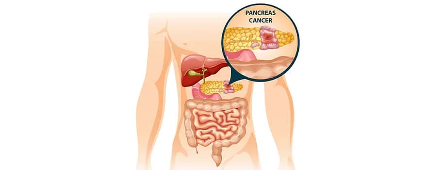 Pancreatic cancer