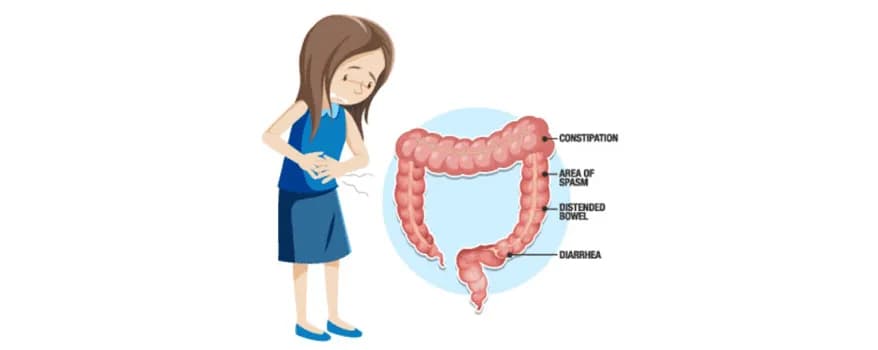 Irritable Bowel Syndrome