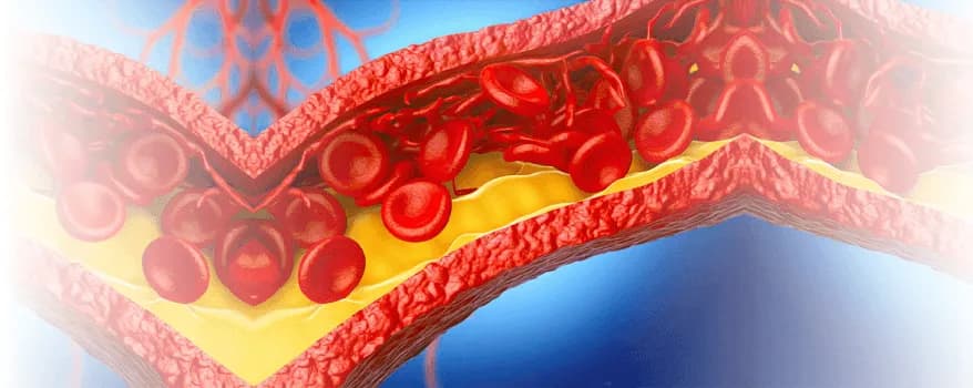 Carotid artery disease