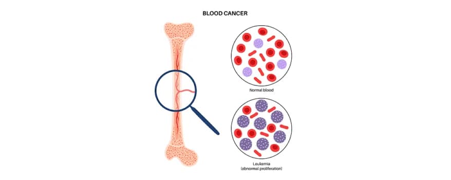 Leukemia