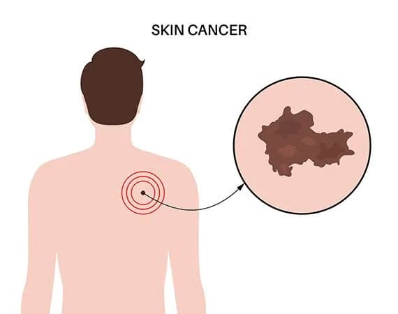 Skin cancer