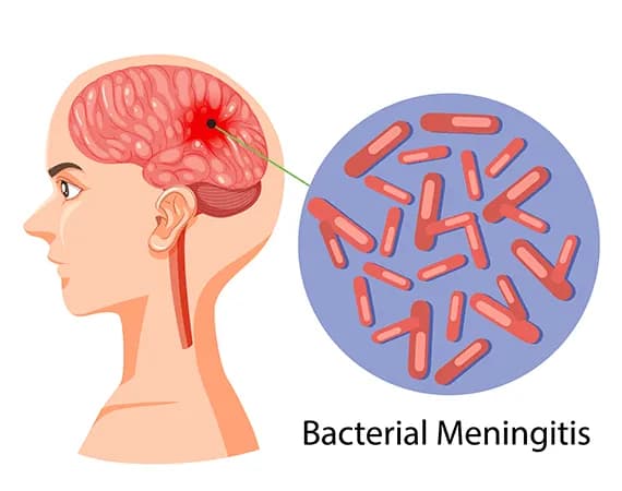 Meningitis