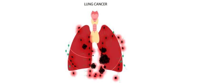 Lung cancer
