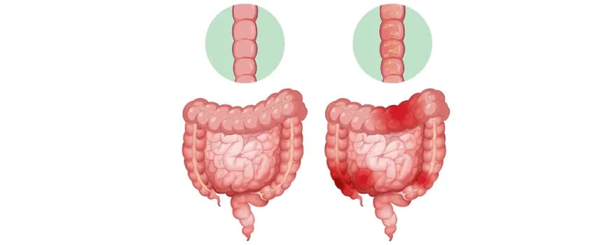 Colitis