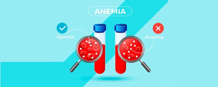 Anemia