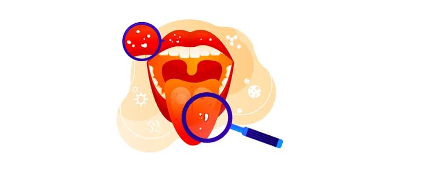 Oral cancer