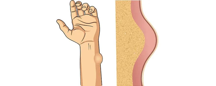 Lipoma