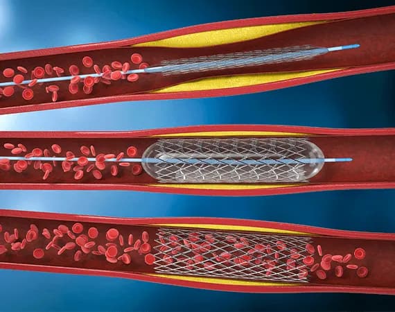 Angioplasty