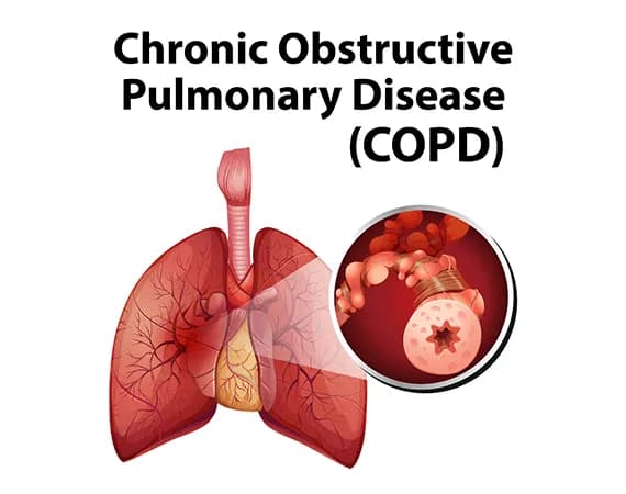 Chronic Obstructive Pulmonary Disease