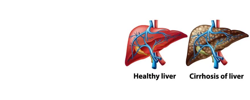 Liver Cirrhosis