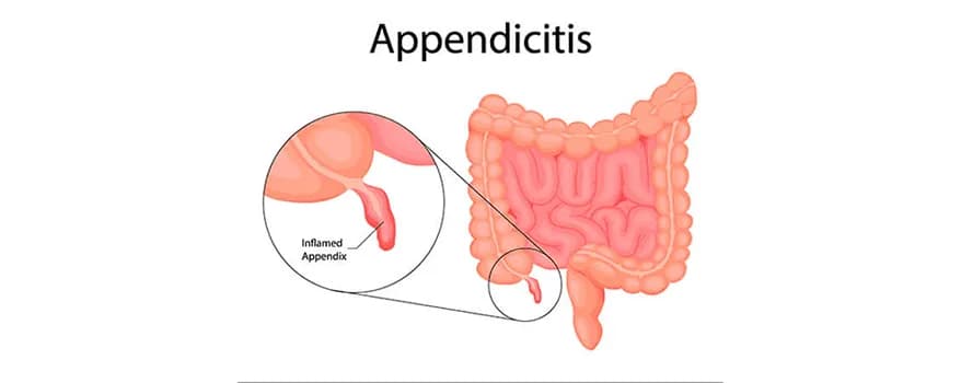 Appendicitis