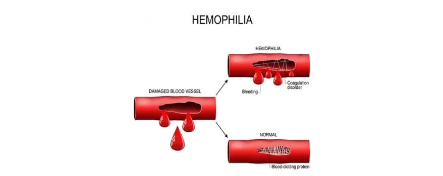 Hemophilia