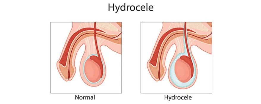 Hydrocele