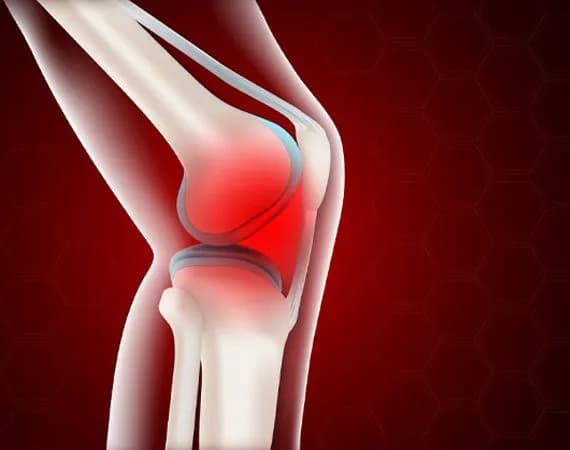 Osteoarthritis