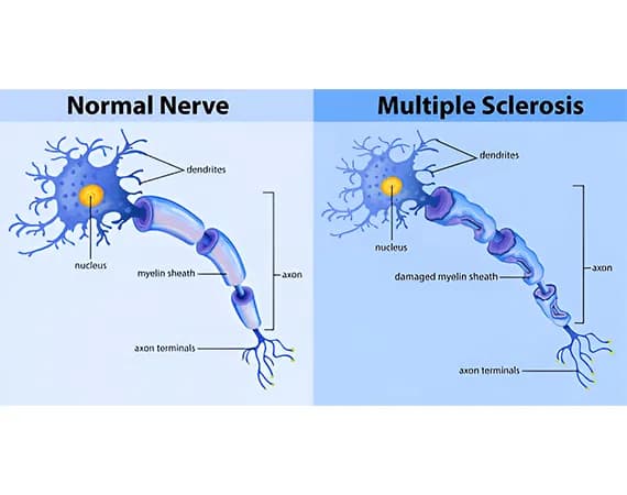 Multiple Sclerosis (MS)