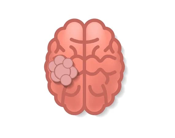 Brain Tumour