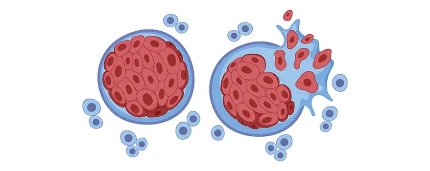 Multiple myeloma