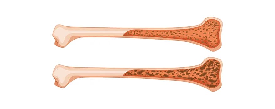 Bone marrow failure