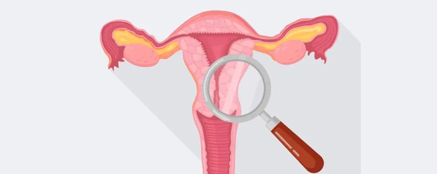 Cervical cancer