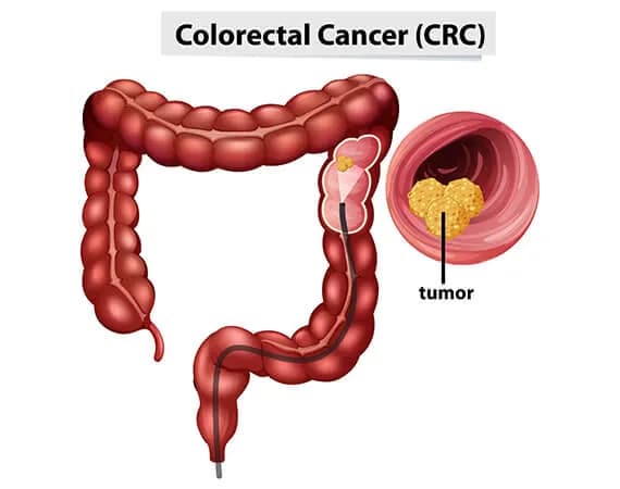 Colorectal cancer