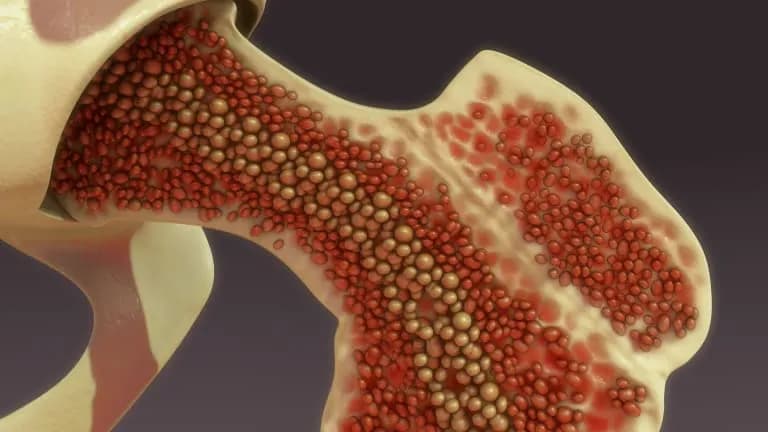 Types of Blood Cancer That Require a Bone Marrow Transplant