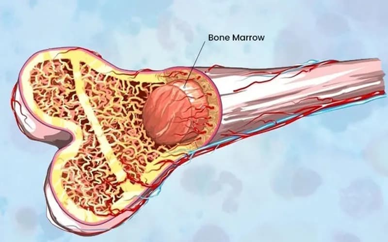 Aplastic Anemia and Bone Marrow Transplant: When Is It Necessary?
