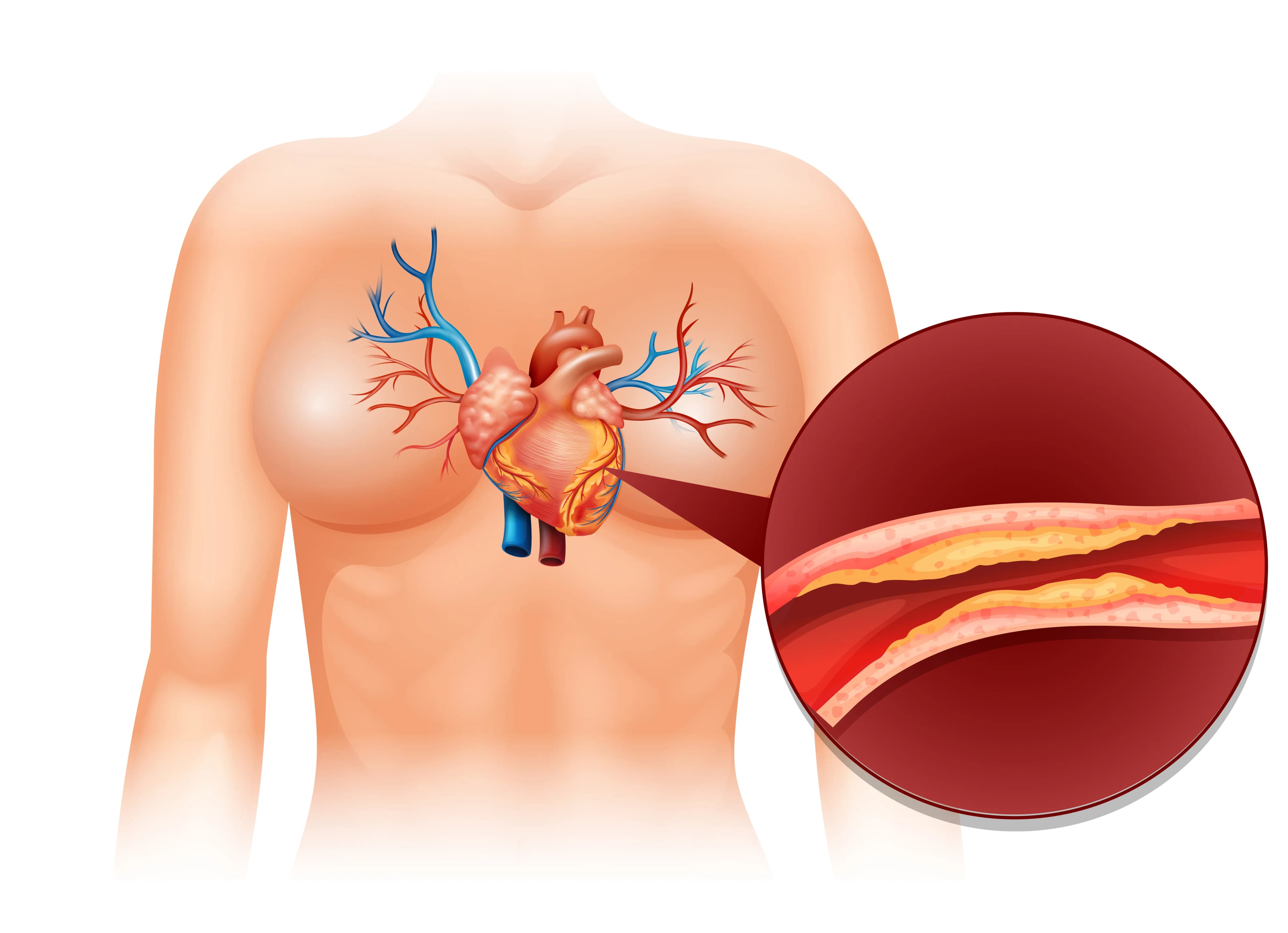 Bypass Surgery vs Angioplasty: What's the Difference?